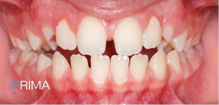 Pedodonzia 4 dentista per bambini a Terni