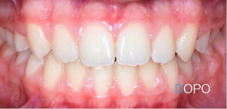 Pedodonzia 5 dentista per bambini a Terni