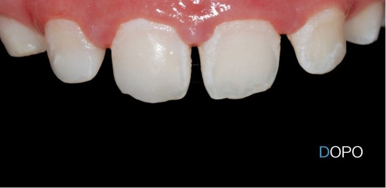 Pedodonzia 7 dentista per bambini a Terni