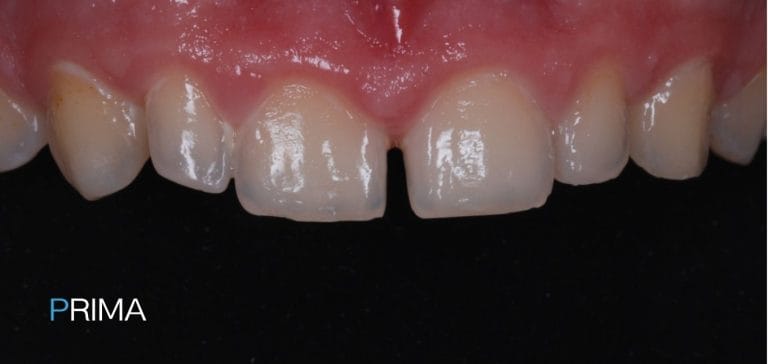 Faccette Dentali 3 faccette dentali a Terni