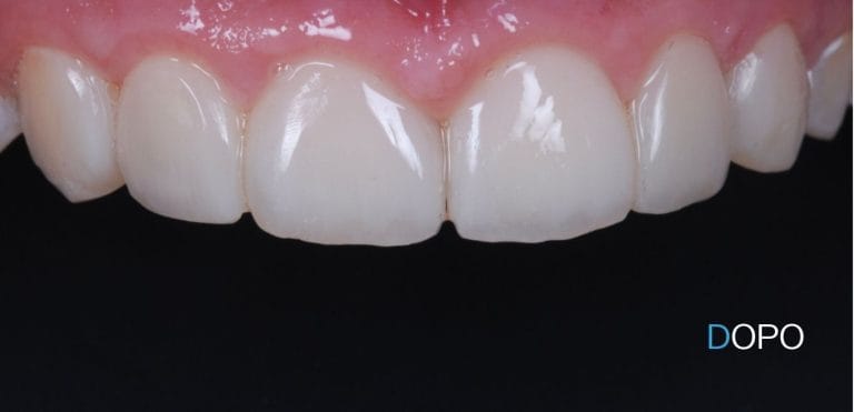 Faccette Dentali 4 faccette dentali a Terni