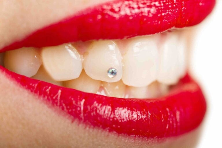 Brillantini dentali Brillantini dentali