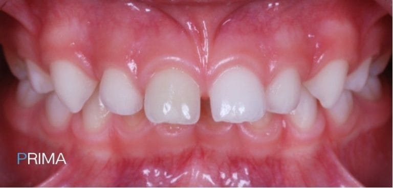Pedodonzia 8 dentista per bambini a Terni