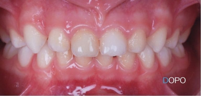 Pedodonzia 9 dentista per bambini a Terni