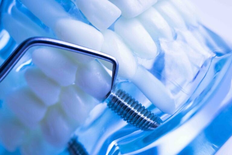 glossario implantologia