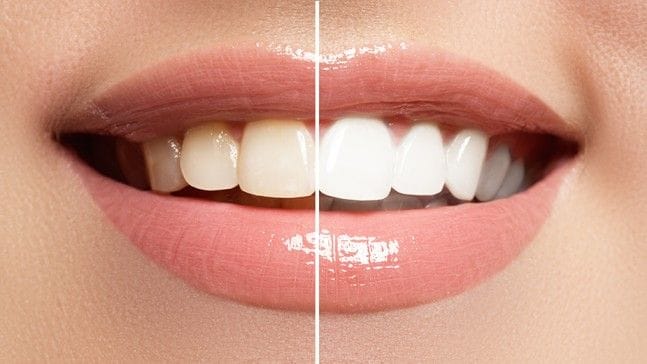 News 10 sbiancamento-denti (1)